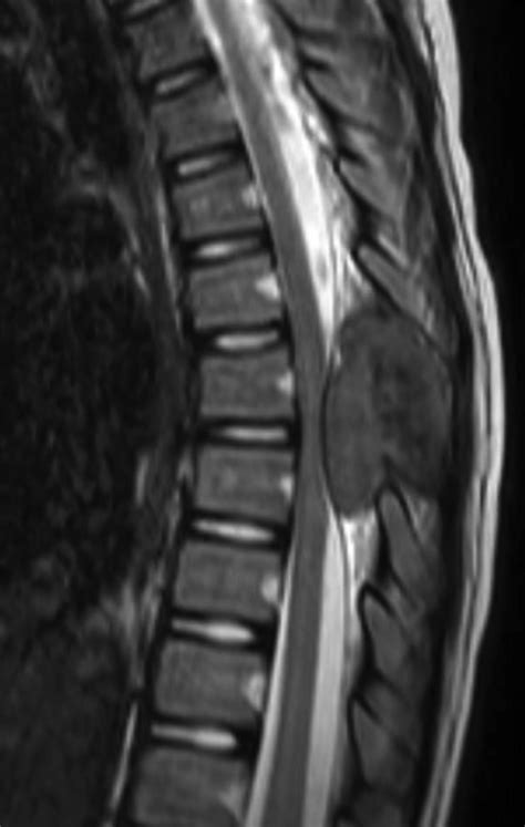 Spinal Giant Cell Tumor • APPLIED RADIOLOGY