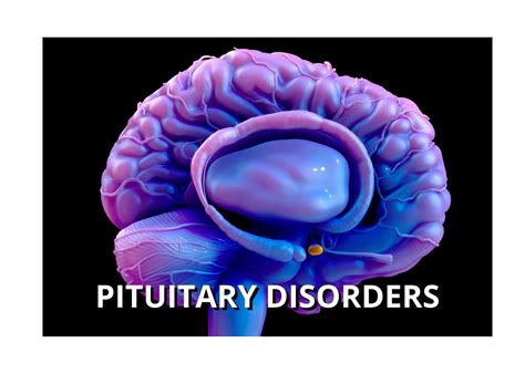 Pituitary Disorders | District Endocrine