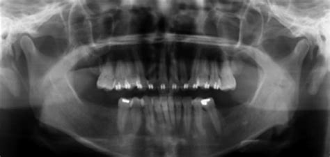 Case 1 panoramic film findings. Preoperative panoramic radiograph ...