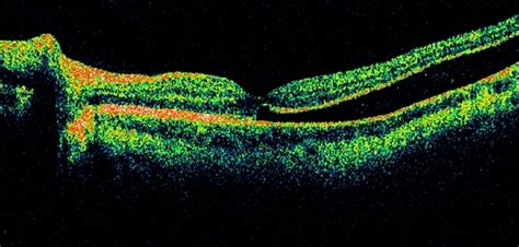 Macula off Rhegmatogenous Retinal Detachment - Retina Image Bank