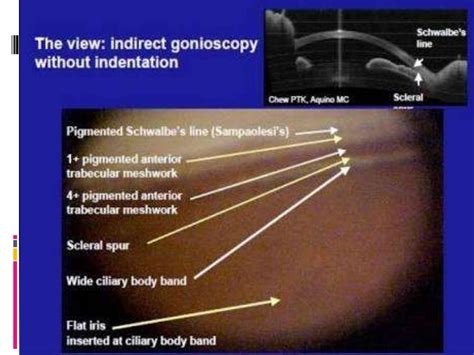 Gonioscopy: gonioscopic lenses, principle and clinical aspects