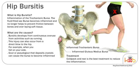 Hip labral tear famous athletes wtp, sleeping after eating during ...