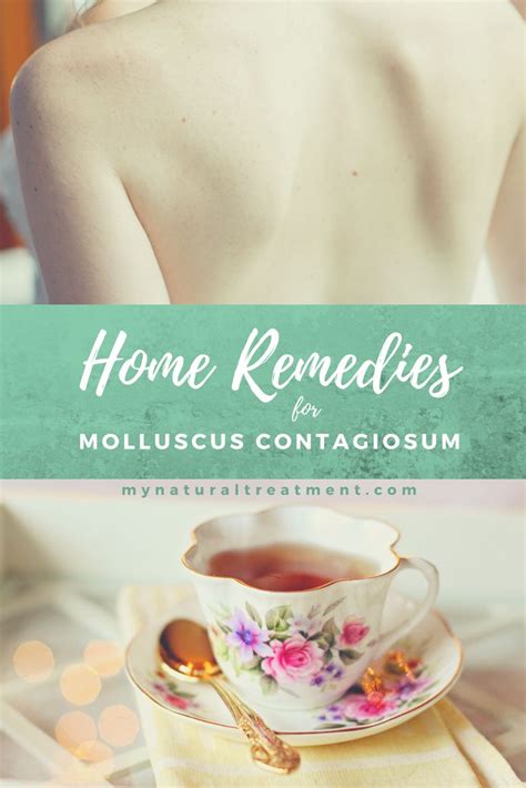 10 Home Remedies for Molluscum Contagiosum with instructions # ...