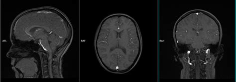 Brain MRA Protocols and Planning | Indications for MRA Brain Scan