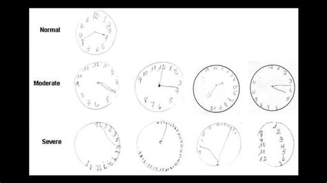 Researchers Assess Usefulness of Clock Drawing Cognitive Test in ...