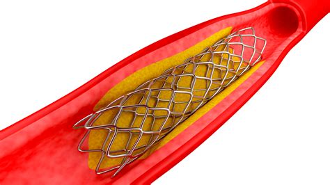 Angina, Angioplasty, Bypass, CAD, Heart Attack, Stent - AOPA