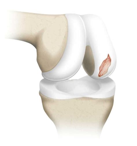 Chondral Injury | Chondral Lesion | Chondral Defect | Orthopedic Knee ...