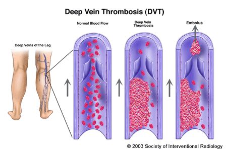 Deep Vein Thrombosis (DVT) Treatment in Clearwater