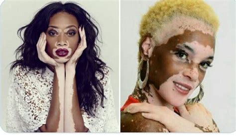 Vitiligo: Facts, Myths, Causes, Symptoms, Pictures, Treatment ...