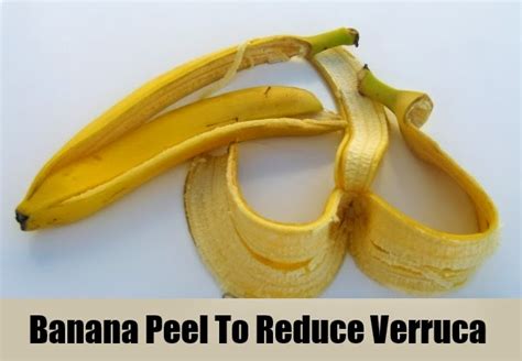 6 EFFECTIVE HERBAL REMEDIES FOR VERRUCA ~ Mzizi Mkavu