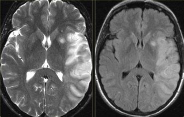 Stroke Brain Mri