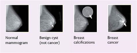 Breast Changes And Conditions National Cancer Institute