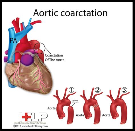 Coarctation Of The Aorta In Infants - ScienceHUB