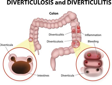 Diverticulitis: Causes, symptoms, and treatments