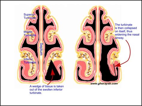 Turbinate Reduction Nasal (turbinectomy) Surgery In Iran | Medpersia ...