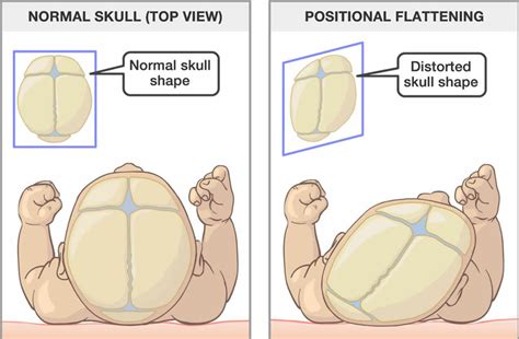 Plagiocephaly causes, symptoms, diagnosis & treatment