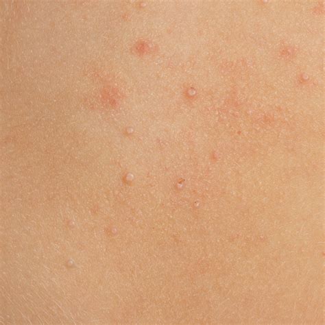 Molluscum Contagiosum - South Florida Dermatology