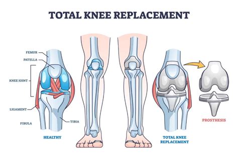 What To Expect 1 Year After Total Knee Replacement - Heiden Orthopedics