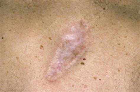 Scar on the skin after cancer removal - Stock Image - C008/5761 ...