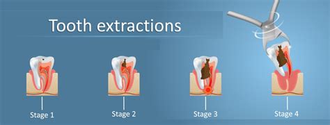 Top Ten Reviews How Long to Take Paracetamol After Tooth Extraction ...