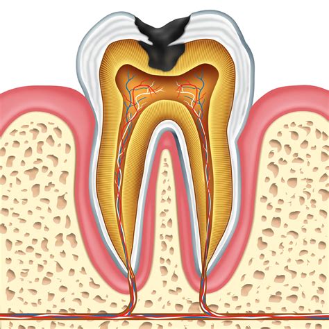 Lincoln, NE Tooth Decay and Missing Teeth: Restorative Dentistry and ...