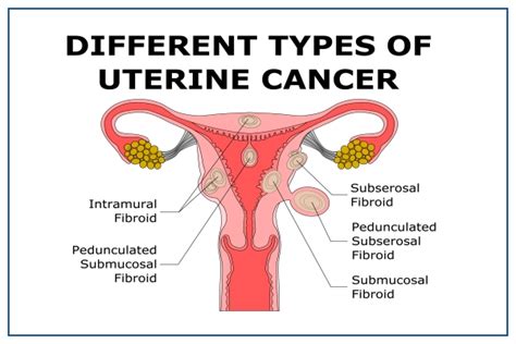 Uterine Cancer - Causes, Symptoms, Diagnosis And Treatment | Medicover