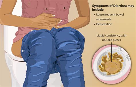 How Can Brainerd Diarrhea Be Diagnosed? - StoryMD