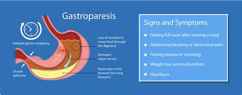 How To Treat Gastroparesis Without Medication