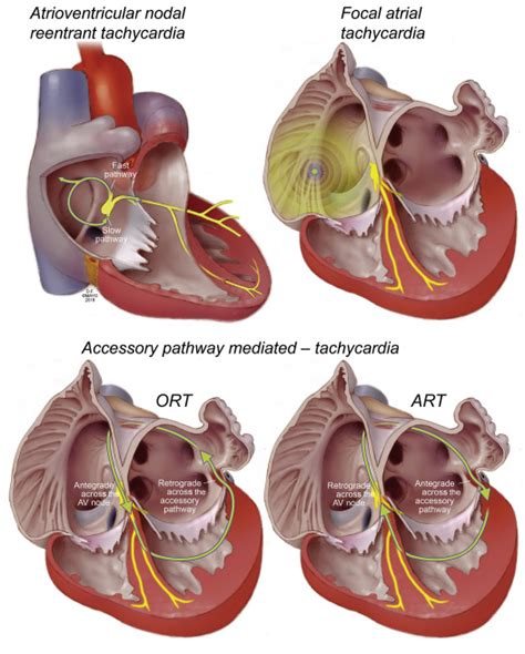 Supraventricular Arrhythmias: Clinical Framework and Common Scenarios ...