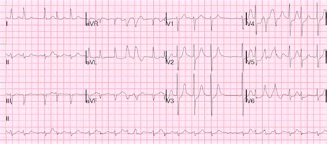 Dr. Smith's ECG Blog: Atrial fibrillation with RVR: use POCUS to assess ...