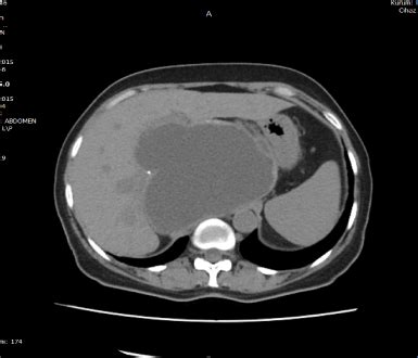 Postoperative fluid collection in a patient with hydatid cyst of the liver