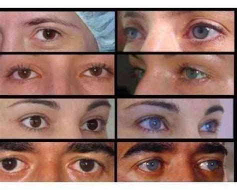 Eye Color Surgery Before and After | Health Pictures | Eye color, Eye ...