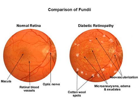 Fundus Photography - Coatsworth Eye Clinic