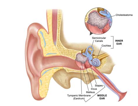 Cholesteatoma | Professor Marcus Atlas