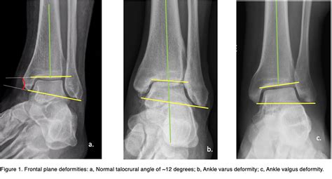 Valgus Vs Varus Of Ankle