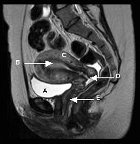 Mri Female Pelvis Anatomy