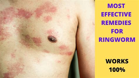 RINGWORM|Home remedies for ringworm|Ringworm treatment at home|Tinea ...