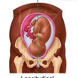 Bell Clapper Deformity and Testicular Torsion Illustration by Keri ...