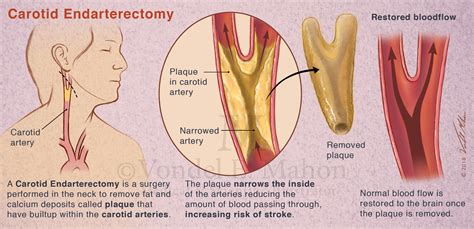 Carotid Endarterectomy Procedure for Patient Education – Mahon ...