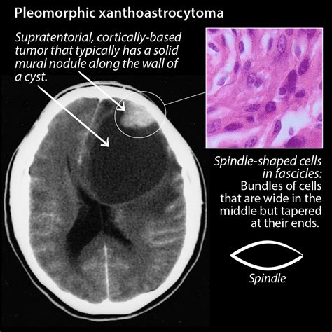 Clinical Pathology Glossary: Pleomorphic Xanthoastrocytoma | ditki ...