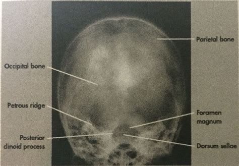 Townes method for skull (30 degrees caudal) | Radiography, X ray ...