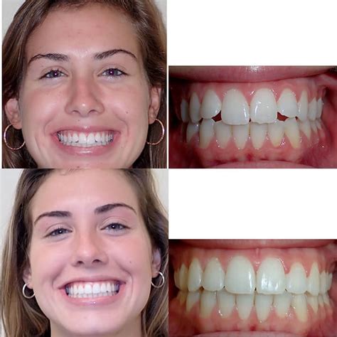 Before & After Invisalign | Wazio Orthodontics