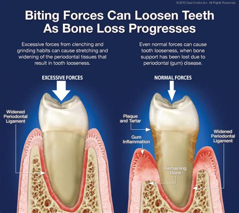 Loose Teeth | Treatments in Ottawa, IL by Dr. Conness