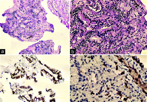 (a and b) Histopathology suggestive of invasive mucinous... | Download ...