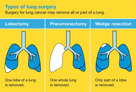 Types Of Lung Cancer Tumors