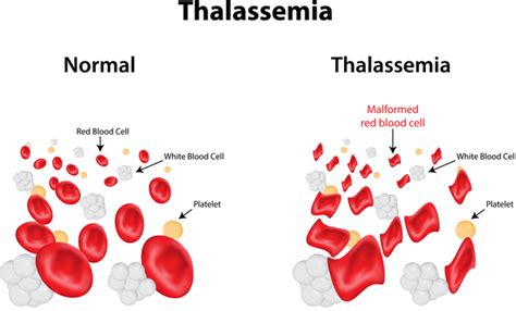 Beta-thalassemia: Causes, types, symptoms, diagnosis, and treatment ...