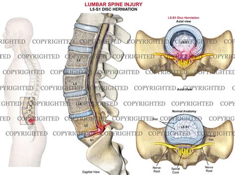 Lumbar spine disc herniation L5-S1 - male — Medical Art Works