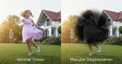 Protecting Your Vision From Age-Related Macular Degeneration | Malik ...