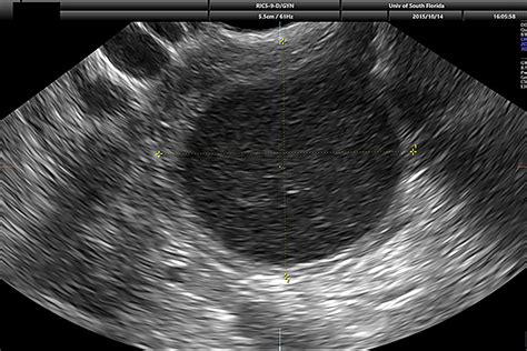 Ovarian Cyst On Ultrasound Image