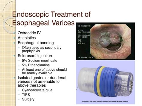 Esophageal And Gastric Varices